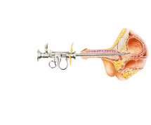 Prostate Surgery Treatment Cost in Delhi