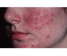 Best Treatment for Rosacea in Delhi At Skinology