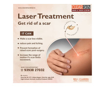 vascular laser treatment in bangalore