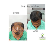 Hair transplant in Hyderabad
