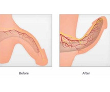 Erectile Dysfunction Treatment by Dr. Niren Rao