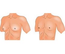 Gynecomastia Surgery in Thane | Male Chest | Pristinecosmesis