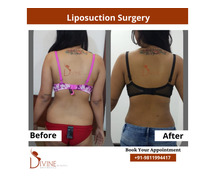 Best Liposuction results at divine cosmetic surgery