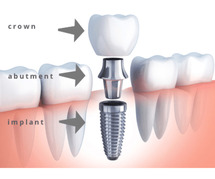Exact Estimate of Dental Implant Cost in Gurgaon: Aspen Dentals Clinic