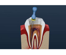 Root Canal Treatment in Noida