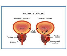 Prostate Cancer Treatment