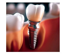 Best Dental Implants in Ahmedabad - Dr. Robin’s Dental Clinic
