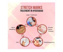 Stretch Marks Treatment in Hyderabad