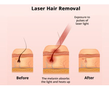 Laser hair removal in Hyderabad