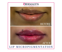 Lips Micropigmentation in Delhi