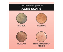 Acne scar treatment in Hyderabad