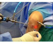 ACL Ligament Surgery Cost in Rajasthan