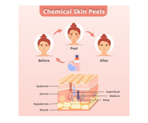 chemical peel treatment in hyderabad