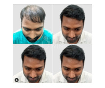 Hair Transplant in Delhi: Affordable Excellence at Divine Cosmetic Surgery