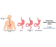Endoscopic Sleeve Gastroplasty: A Minimally Invasive Weight Loss Procedure