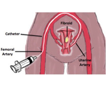 Uterine Fibroid Treatment In India