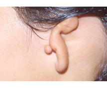 Ear Reconstruction Surgery - The Microtia Trust