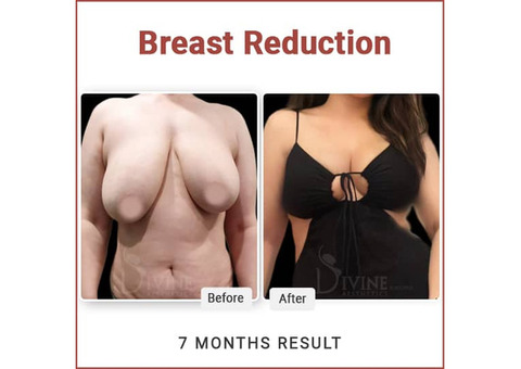 Breast Reduction Surgery in India | Dr. Amit Gupta