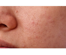 Open pores treatment in Hyderabad