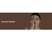 Acne scar treatment in Faridabad