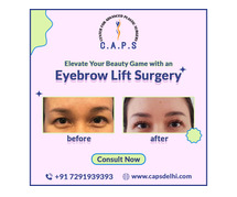 Eyebrow Lift Surgery In Delhi