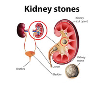 Contacting Dr. Niren Rao, a Kidney Stone Specialist in Delhi, will help you get rid of kidney stones