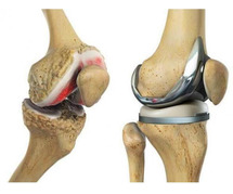 Best Joint Replacement Surgeon in Bhopal - Dr. Vivek Tiwari