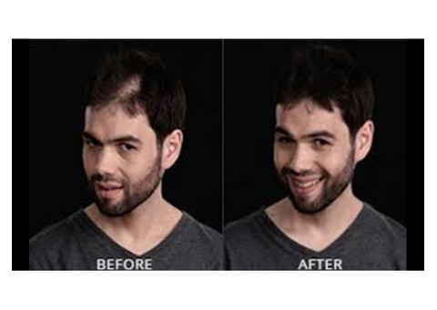 Hair Fixing in Bangalore-Hair Fixing Services-Hair Fixing Treatment-Hair Weaving Services