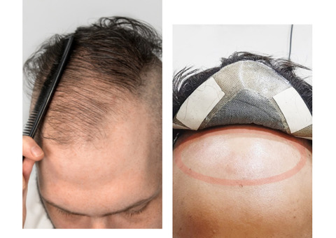 Hair Replacement in Bangalore-Hair Replacement Center