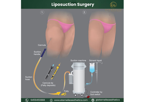 Liposuction surgeon in Hyderabad. Eternelle Aesthetics Is a Best Plastic Surgery Clinic