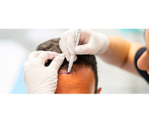 Cost-effective Hair transplant cost in Jaipur