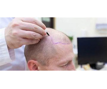 Hair Transplant Cost in Rajasthan