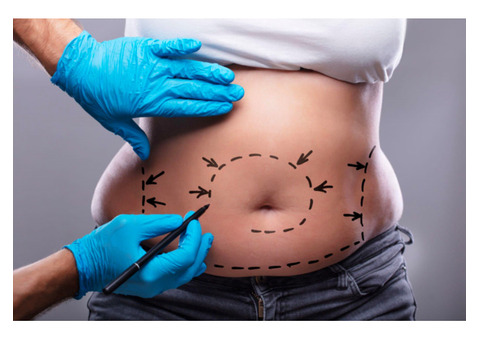 Liposuction Surgery Cost in Jaipur