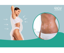 Best Tummy Tuck | Liposuction Clinic in Bangalore: Anew Aesthetic