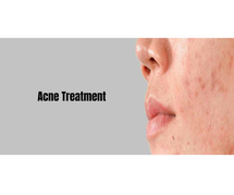 Acne Scar Reduction In Bangalore