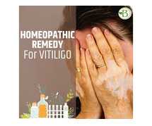 Vitiligo homeopathic treatment