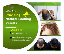 Natural-Looking Results: Hair Fixing Services Available @Sarjapur