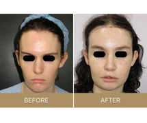 Facial Feminization Surgery Cost in India