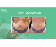 Best Laser Liposuction Treatment In Bangalore