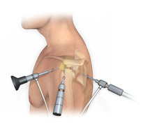 Robotic Total Knee Replacement