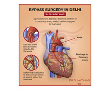 Best Bypass Surgeon In Delhi- Dr. Sujay Shad