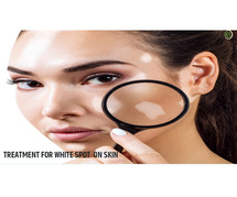 Effective Skin White Spot Treatments: Methods for Restoring Pigmentation