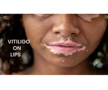 Understanding and Managing Pigment Loss in Lip Vitiligo
