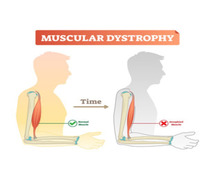 Successful Treatment of Muscular Dystrophy in India - MedTravellers