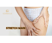 Stretch Mark Removal Treatment In Hyderabad - Eternelle Aesthetics
