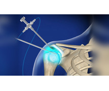 Get an Appointment of Shoulder Arthroscopy Surgery in Delhi