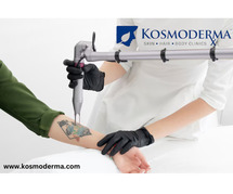 Expert Laser Tattoo Removal in Delhi | Safe & Effective | Kosmoderma Clinic