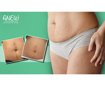 Best Stretch Marks Treatment in Bangalore - Anew Cosmetic Clinic
