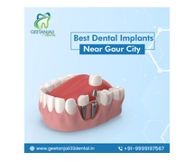 Best Dental Implants Near Gaur City