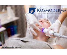 Laser Treatment for Acne in Delhi | Effective Pimple and Acne Treatment at Kosmoderma